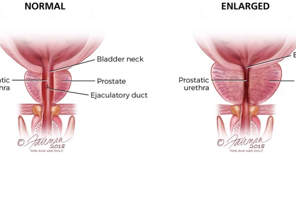 Practical Tips: What Is The Cost Of Prostatic Hyperplasia Treatment