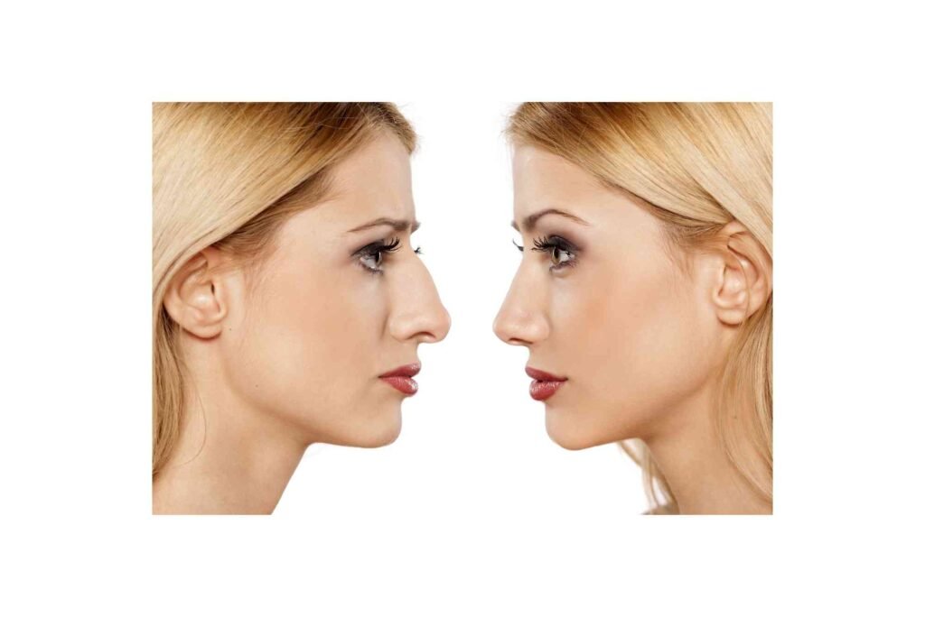Practical Tips: Much Does Rhinoplasty In Turkey Cost
